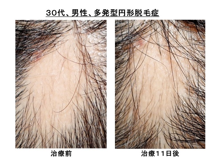円形脱毛症　病院